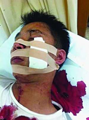 王老吉加多宝员工苏州冲突 一人脸划伤缝20多针 图