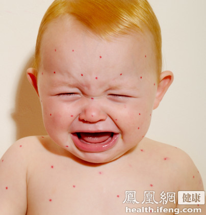 北京已进入麻疹高发季节